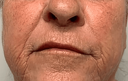 Advanced facial remodeling with Morpheus8 — before treatment