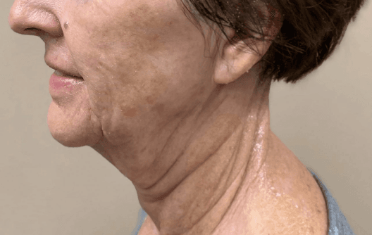 Advanced facial remodeling with Morpheus8 — before treatment