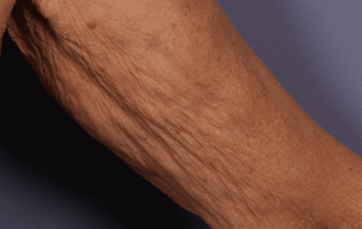 Body contouring and fat reduction with Morpheus8 Body — before treatment