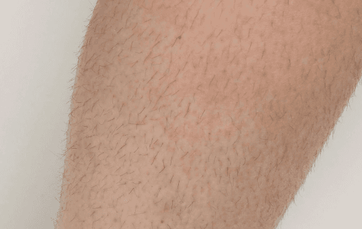 Laser hair removal with DiolazeXL — before treatment