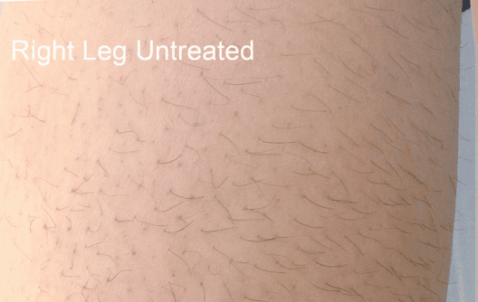 Laser hair removal with DiolazeXL — before treatment