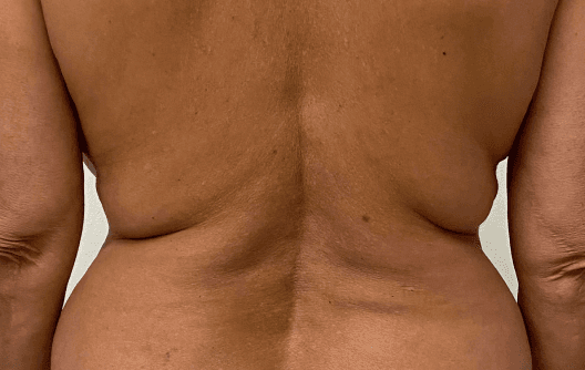 Body contouring and fat reduction with Morpheus8 Body — before treatment