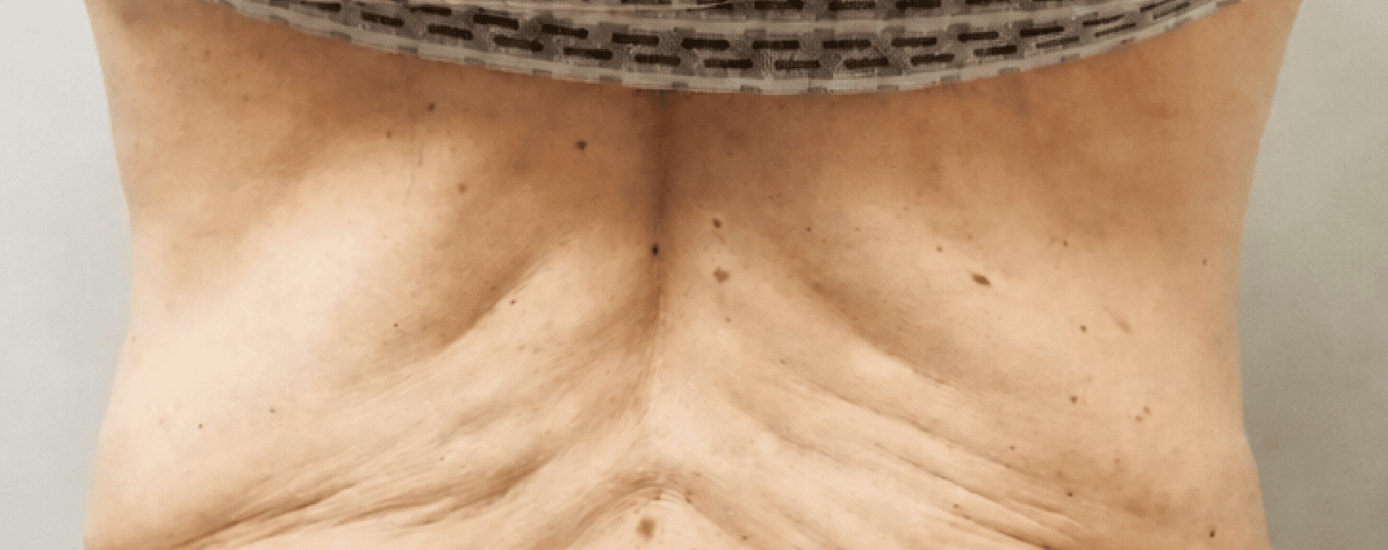 Back Contouring — before