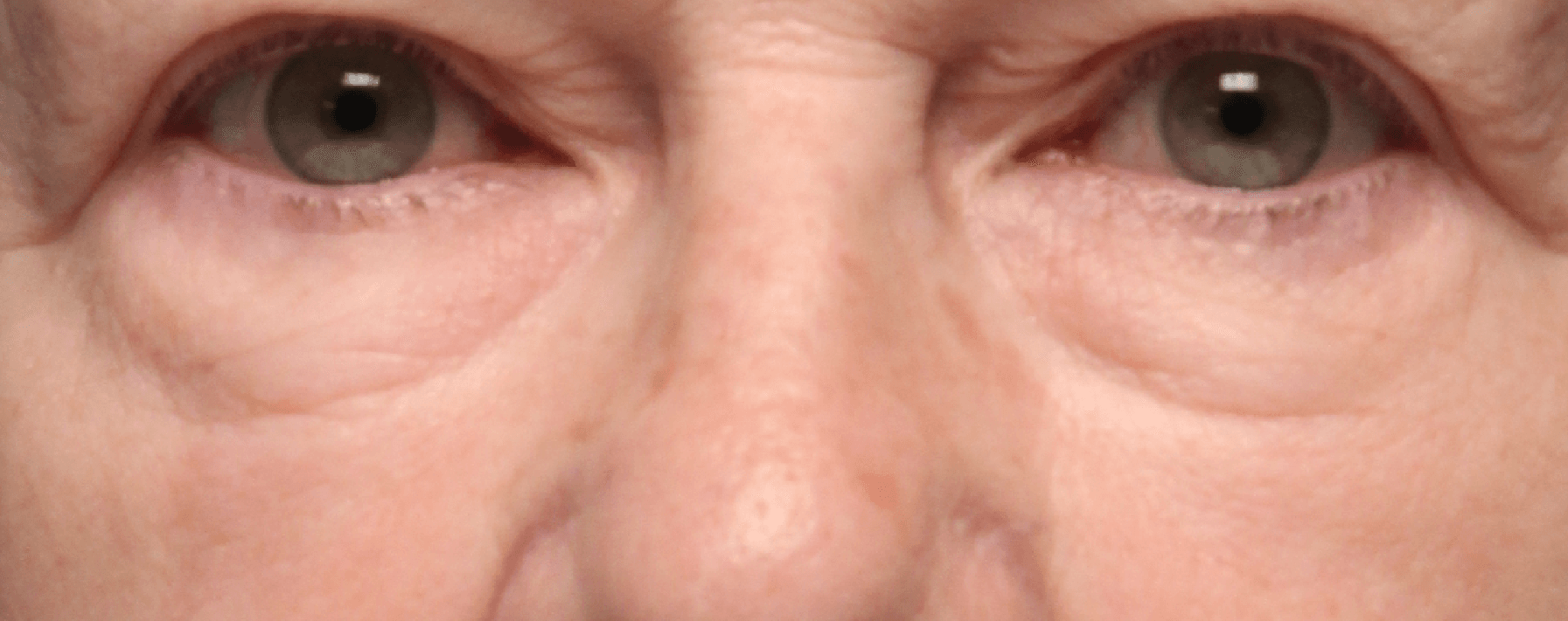 Under-Eye Hollows & Bags — before