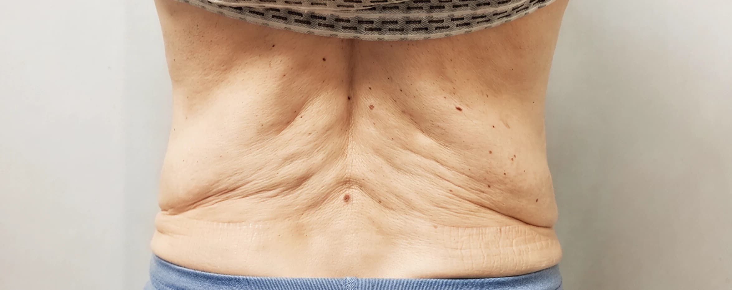 Back Contouring — before