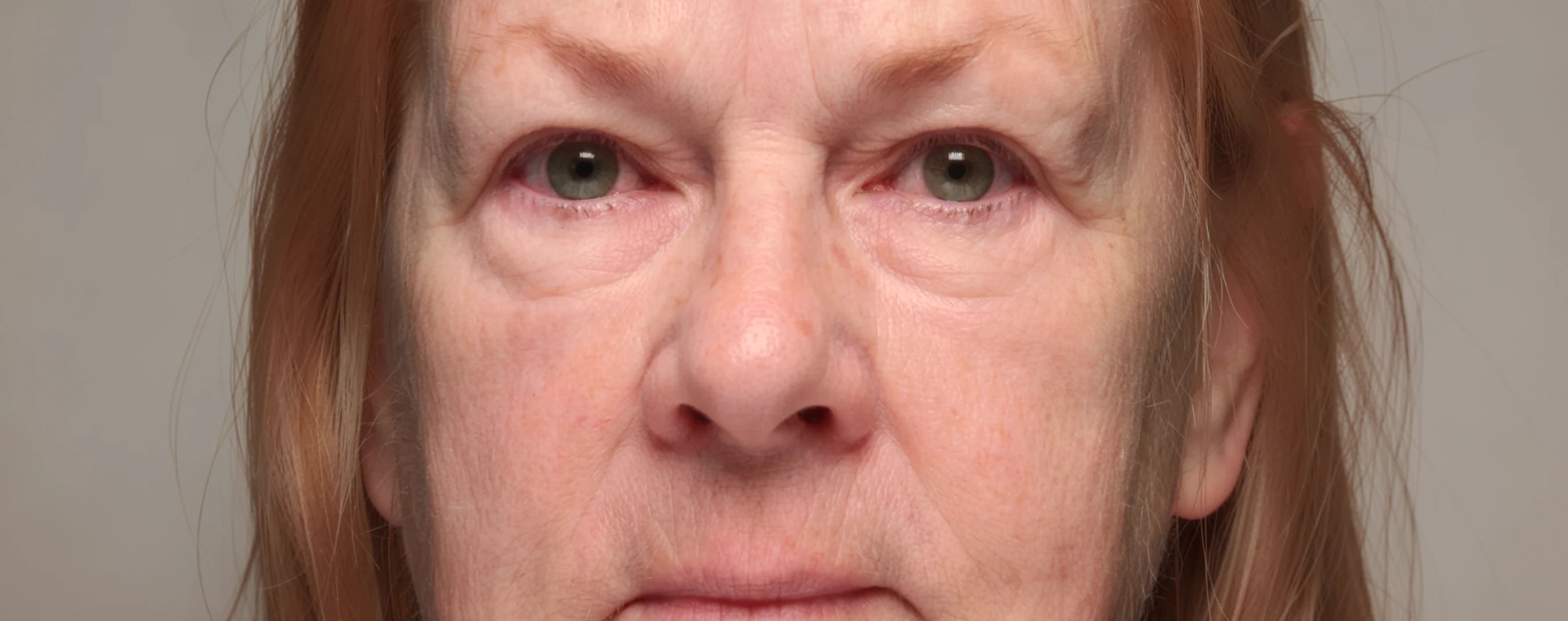 Under-Eye Hollows & Bags — before