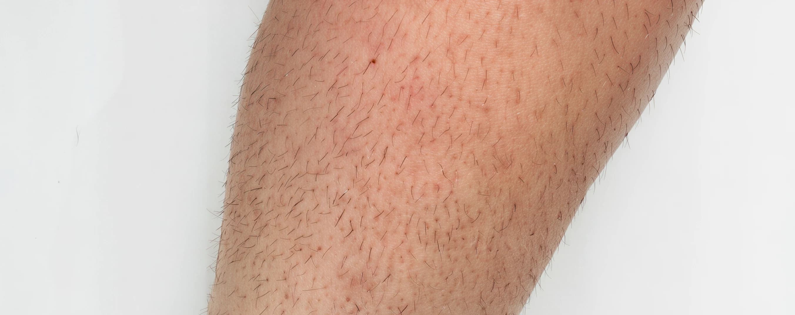 Permanent Hair Reduction — before