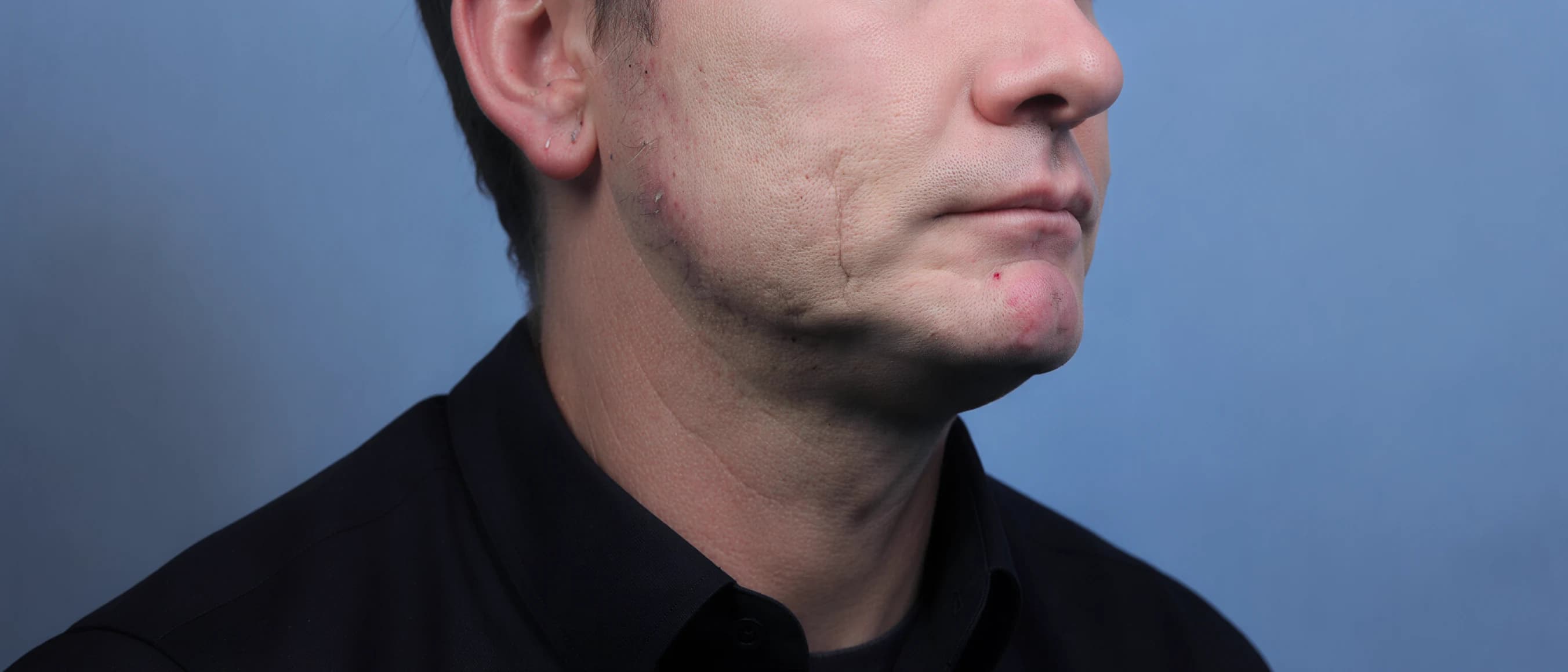 Scar & Skin Texture Improvement — before