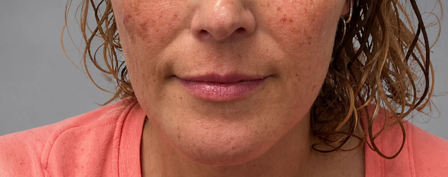 Facial Pigmentation Reduction — before