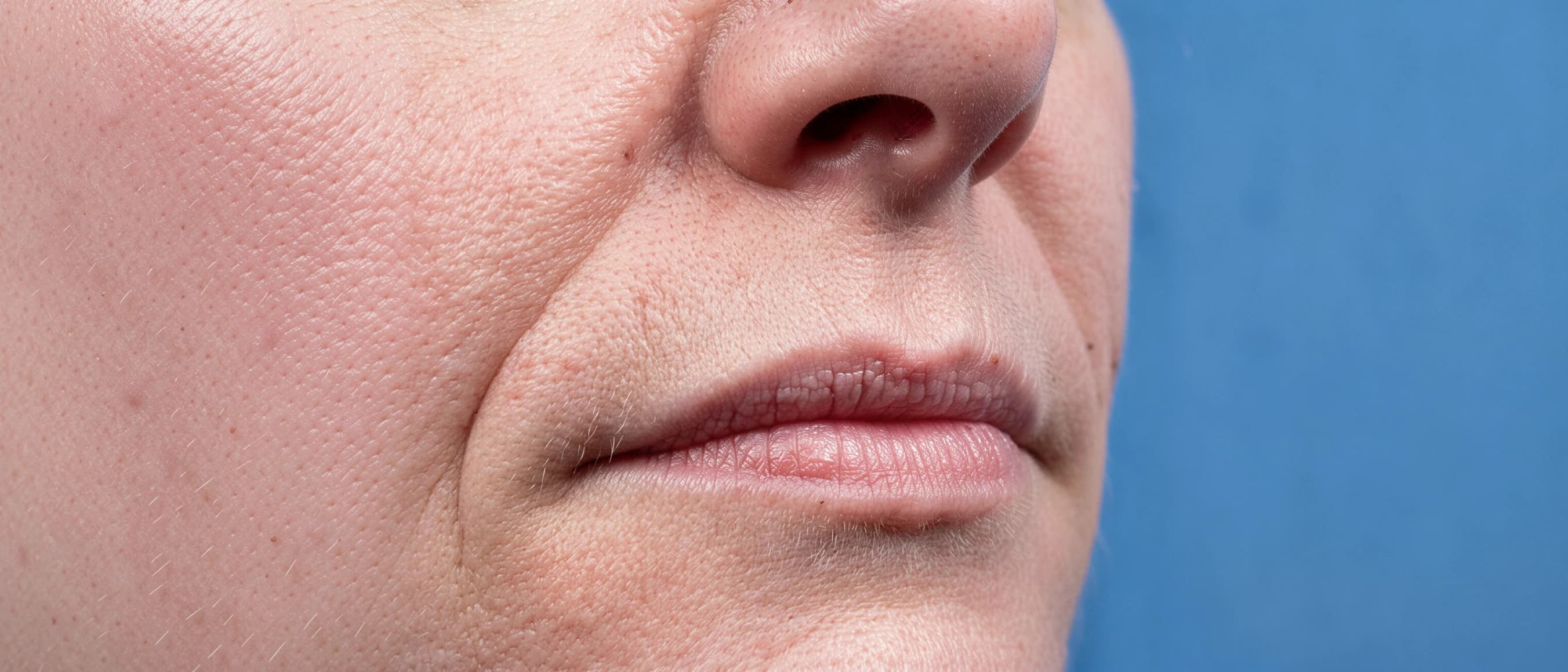 Lip & Perioral Line Smoothing — before