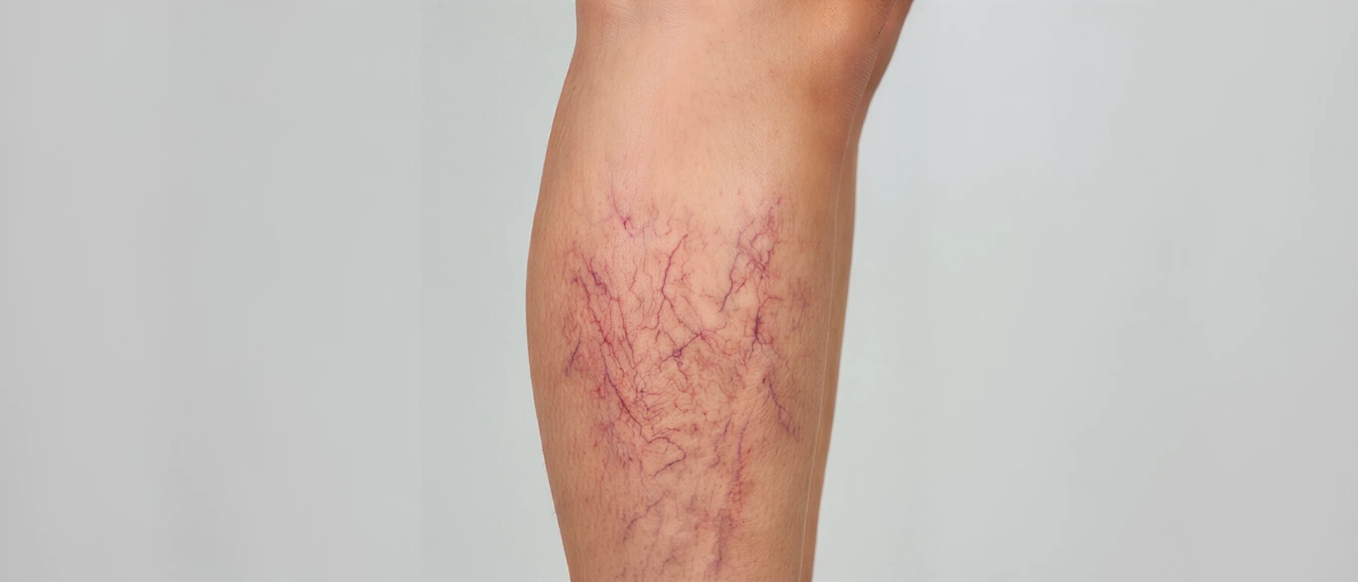 Spider Vein Treatment — before